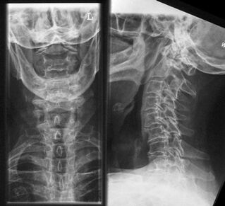Рентген шийного відділу - метод діагностики остеохондрозу