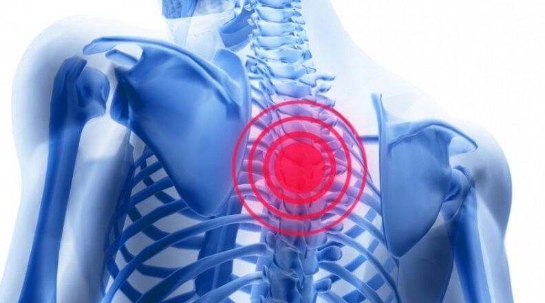 біль в спині може бути пов'язана з грижею міжхребцевого диска