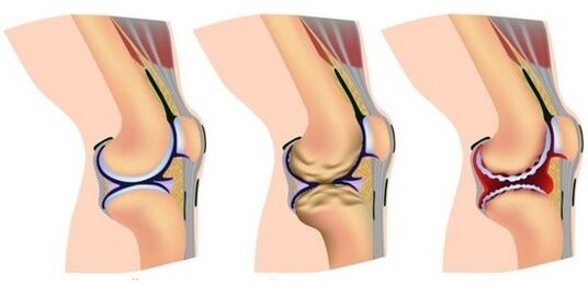 здоровий суглоб та болі при руйнуванні колінного суглоба