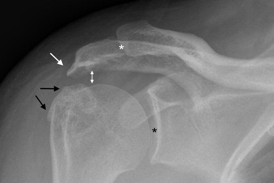 артроз плечового суглоба на рентгенівському знімку
